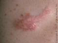 Keloid Scar Removal